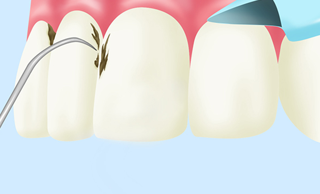 歯石除去（歯のクリーニング）